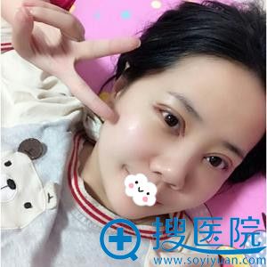 <!--<i data=20240710 data-id=12341></i>-->姚盛雷切开双眼皮+开眼角效果 <!--<i data=20240710 data-id=12341></i>-->姚盛雷切开双眼皮+开眼角效果
