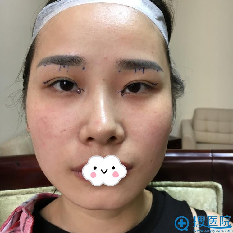 <!--<i data=20240710 data-id=8402></i>-->黄海彬双眼皮真人案例 <!--<i data=20240710 data-id=8402></i>-->黄海彬双眼皮真人案例