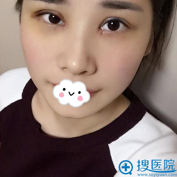 <!--<i data=20240710 data-id=8402></i>-->黄海彬切开双眼皮效果怎么样 <!--<i data=20240710 data-id=8402></i>-->黄海彬切开双眼皮效果怎么样