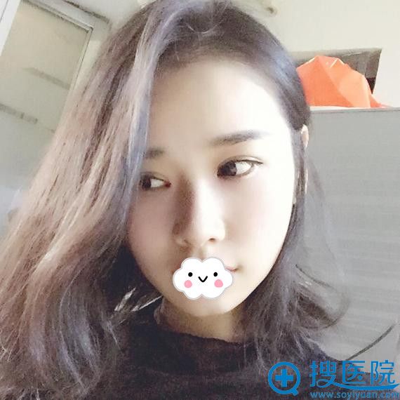 <!--<i data=20240710 data-id=8402></i>-->黄海彬双眼皮+开眼角效果 <!--<i data=20240710 data-id=8402></i>-->黄海彬双眼皮+开眼角效果