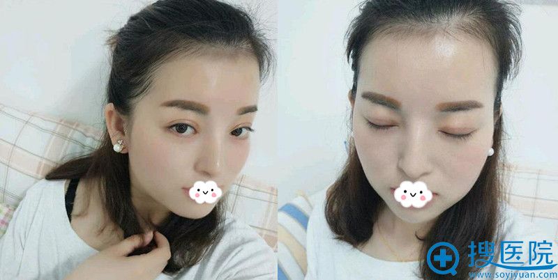 �����ʰ����紺��˫��Ƥ�����޺�Ч����Ȼ��