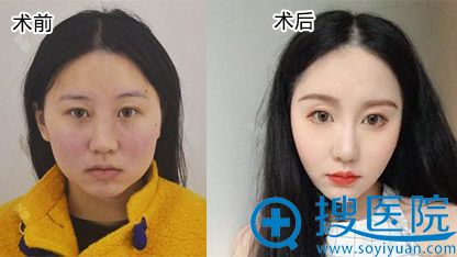 大脸变V脸,看我在武汉洪山爱美汇找瞿敏院长做面部吸脂效果