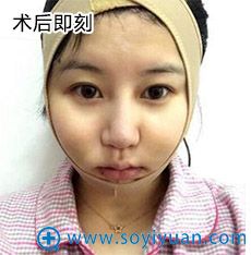 武汉爱美汇面部吸脂案例 武汉爱美汇面部吸脂案例