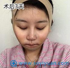 武汉爱美汇面部吸脂案例 武汉爱美汇面部吸脂案例