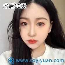 武汉爱美汇面部吸脂案例 武汉爱美汇面部吸脂案例