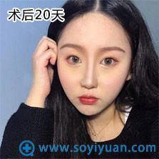 武汉爱美汇面部吸脂案例 武汉爱美汇面部吸脂案例