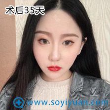 武汉爱美汇面部吸脂案例 武汉爱美汇面部吸脂案例