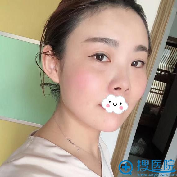 想做鼻整形到扬州艾菲斯后黄院长建议膨体+自体软骨隆鼻效果好