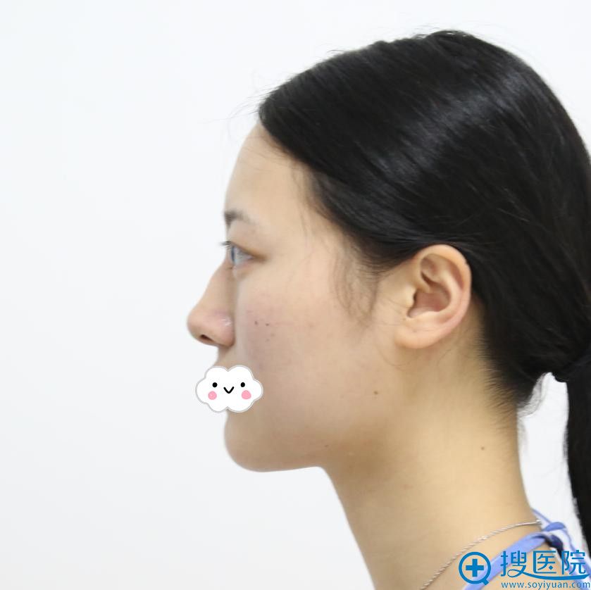 我的美鼻不是梦,到长沙华韩华美做鼻整形车柄勋将驼峰鼻矫正