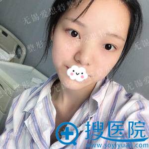 无锡爱思特假体隆鼻效果怎么样 无锡爱思特假体隆鼻效果怎么样