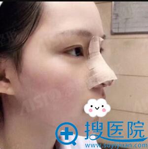 无锡爱思特鼻综合整形术后效果 无锡爱思特鼻综合整形术后效果