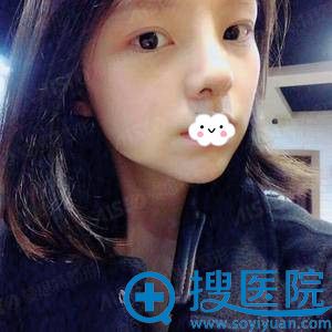 无锡爱思特韩式生科假体隆鼻真人案例 无锡爱思特韩式生科假体隆鼻真人案例