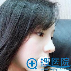 无锡爱思特假体综合隆鼻术后效果怎么样 无锡爱思特假体综合隆鼻术后效果怎么样