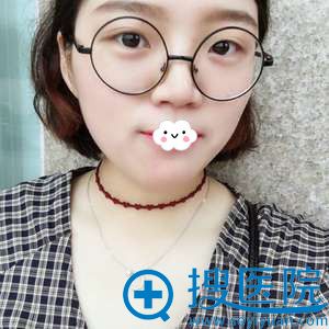 <!--<i data=20240710 data-id=9128></i>-->埋线双眼皮失败修复真人案例 <!--<i data=20240710 data-id=9128></i>-->埋线双眼皮失败修复真人案例