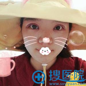 <!--<i data=20240710 data-id=9128></i>-->双眼皮修复术后效果怎么样 <!--<i data=20240710 data-id=9128></i>-->双眼皮修复术后效果怎么样