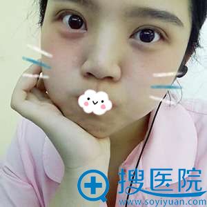<!--<i data=20240710 data-id=9128></i>-->切开双眼皮+开眼角案例 <!--<i data=20240710 data-id=9128></i>-->切开双眼皮+开眼角案例