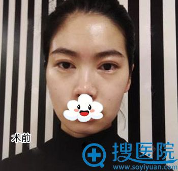 在重庆铂生找杜亚旭院长做面部脂肪填充后变元气少女
