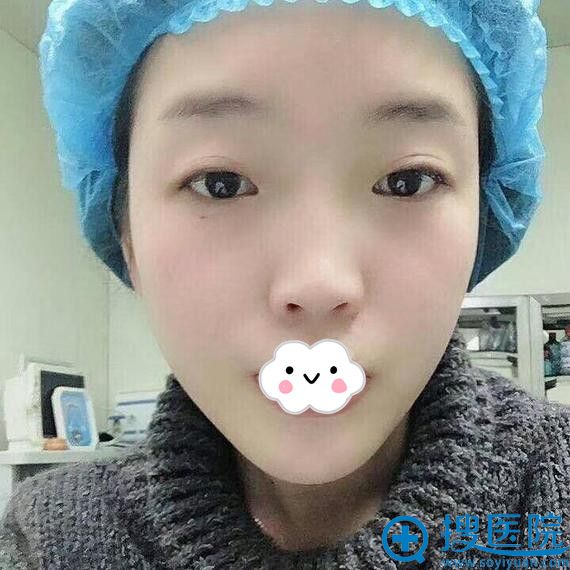只是在恩施华美刘彪处做全切双眼皮+开内眼角后让我如此闪耀