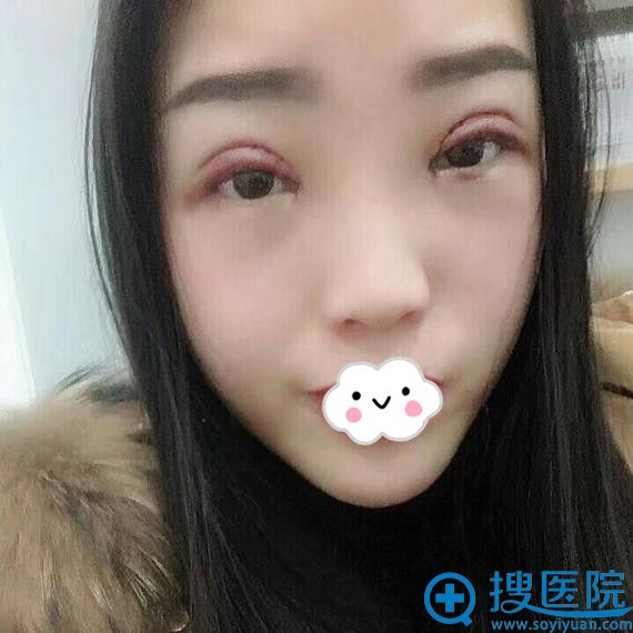 <!--<i data=20240710 data-id=11909></i>-->刘彪全切双眼皮真人案例 <!--<i data=20240710 data-id=11909></i>-->刘彪全切双眼皮真人案例