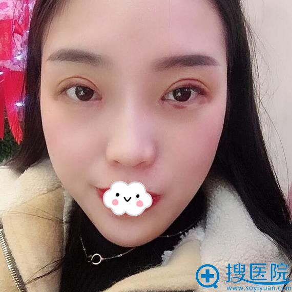 <!--<i data=20240710 data-id=11909></i>-->刘彪双眼皮+开眼角综合整形效果 <!--<i data=20240710 data-id=11909></i>-->刘彪双眼皮+开眼角综合整形效果