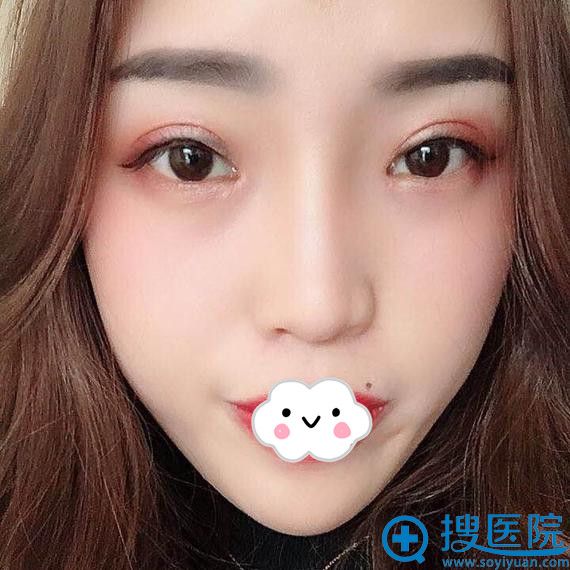 <!--<i data=20240710 data-id=11909></i>-->刘彪全切双眼皮术后效果 <!--<i data=20240710 data-id=11909></i>-->刘彪全切双眼皮术后效果