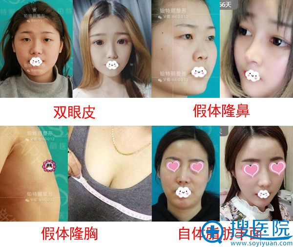昆山铂特丽双眼皮隆鼻隆胸案例对比 昆山铂特丽双眼皮隆鼻隆胸案例对比