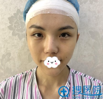 其实隆鼻失败别着急找深圳妍熙陈桂飞重新定制综合美鼻