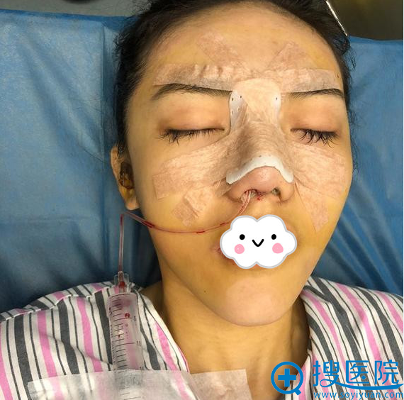 深圳妍熙陈桂飞假体隆鼻失败修复术后效果 深圳妍熙陈桂飞假体隆鼻失败修复术后效果