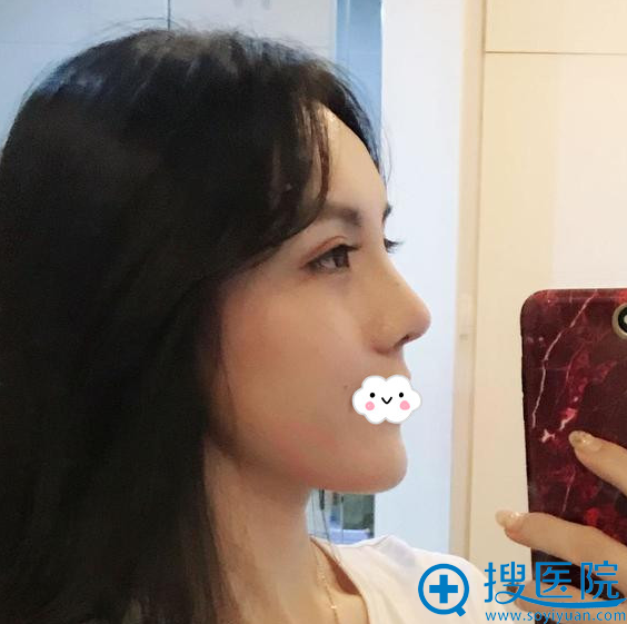 深圳妍熙陈桂飞鼻整形失败修复效果怎么样 深圳妍熙陈桂飞鼻整形失败修复效果怎么样