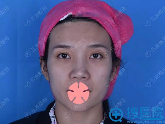 了解过脂肪填充和线雕的区别后,我去重庆五洲做了全脸脂肪填充