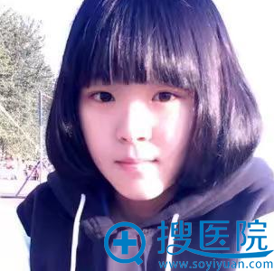 术前肿眼泡单眼皮照片 术前肿眼泡单眼皮照片