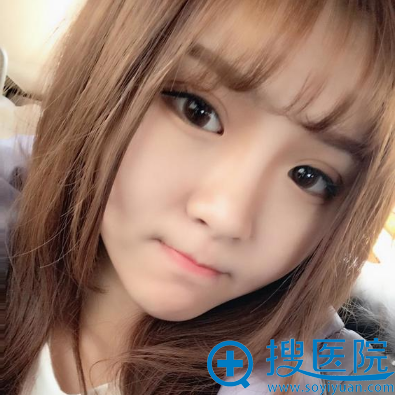 找<!--<i data=20240710 data-id=13535></i>-->孔庆颂做完双眼皮一周拆线效果图 找<!--<i data=20240710 data-id=13535></i>-->孔庆颂做完双眼皮一周拆线效果图