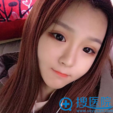 <!--<i data=20240710 data-id=13535></i>-->孔庆颂双眼皮术后 <!--<i data=20240710 data-id=13535></i>-->孔庆颂双眼皮术后