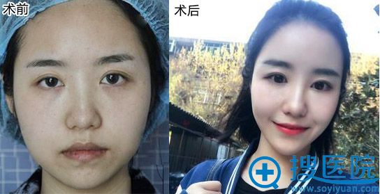 找西安施尔绮苏鹏做面部脂肪填充25天效果:面部饱满又有型