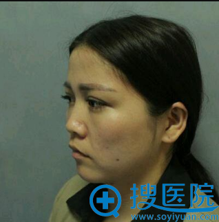 在宁波雅韩拍的术前塌鼻梁照片 在宁波雅韩拍的术前塌鼻梁照片