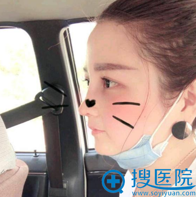 <!--<i data=20240710 data-id=12158></i>-->医院龚涛医生隆鼻术后五天图片 <!--<i data=20240710 data-id=12158></i>-->医院龚涛医生隆鼻术后五天图片