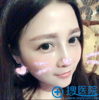 <!--<i data=20240710 data-id=12158></i>-->医院龚涛院长鼻综合隆鼻案例一个月效果图 <!--<i data=20240710 data-id=12158></i>-->医院龚涛院长鼻综合隆鼻案例一个月效果图