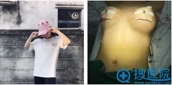 看了海南瑞韩和红妆的案例后找海口华美付德刚做了假体隆胸