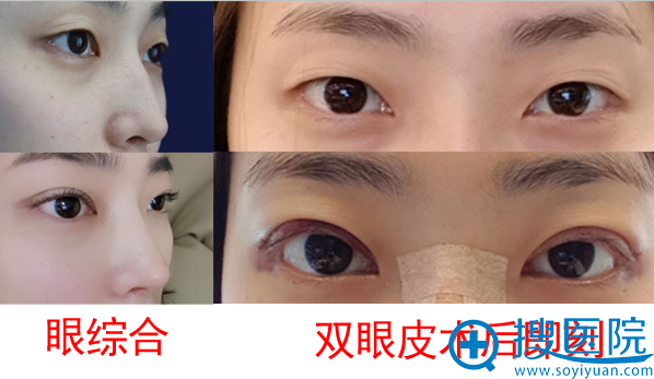 韩国纯真整形医院双眼皮案例 韩国纯真整形医院双眼皮案例