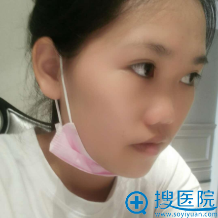 看了海南瑞韩和梦妮幻的案例后找海口红妆朱红振做了鼻综合隆鼻