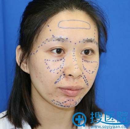 找上海美莱整形医院袁玉坤教授做脂肪填充一个月了效果很不错哦
