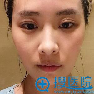 20180727_1532680074545728.jpg 术前.jpg