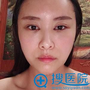 西安韩媚面部填充案例 西安韩媚面部填充案例