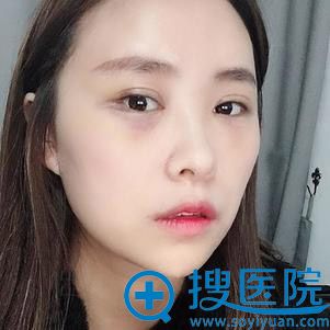 西安韩媚面部填充案例 西安韩媚面部填充案例