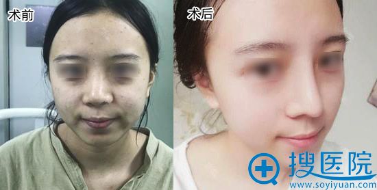 朋友介绍我来武汉洪山爱美汇找瞿敏医生做了鼻综合,来看效果!