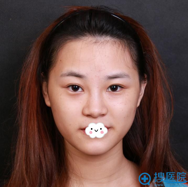 深圳美莱自体耳软骨复合隆鼻效果怎么样 深圳美莱自体耳软骨复合隆鼻效果怎么样