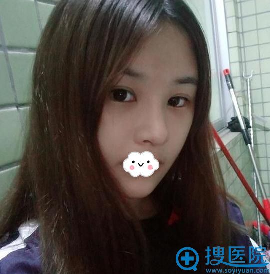 深圳美莱自体耳软骨复合隆鼻真人案例 深圳美莱自体耳软骨复合隆鼻真人案例