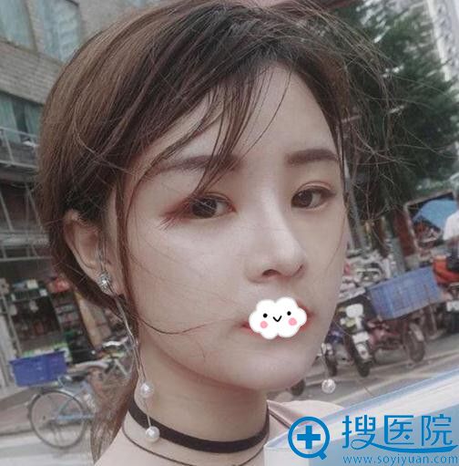 深圳美莱自体耳软骨复合隆鼻术后恢复效果 深圳美莱自体耳软骨复合隆鼻术后恢复效果