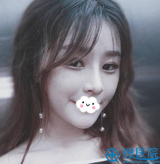 不做假体到深圳美莱耳软骨复合隆鼻效果也挺好 不做假体到深圳美莱耳软骨复合隆鼻效果也挺好
