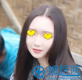 看我案例你就知道济南伊美尔关迪剑假体综合隆鼻效果怎么样了?